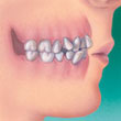 apinhamento-tratamento-ortodontico